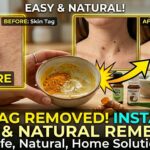 How to Remove Skin Tags at Home with 3 Natural Remedies (That Actually Work)